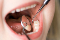 子供の歯の特徴
