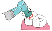 2歯の表面の研磨